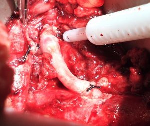 Aortorenal bypass for ruptured renal artery aneurysm